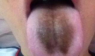 舌头发黑是怎么回事 舌苔发黑是什么病